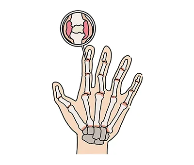 ばね指（重度の腱鞘炎）